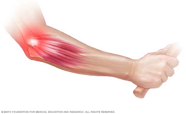 Physical therapy for tennis elbow