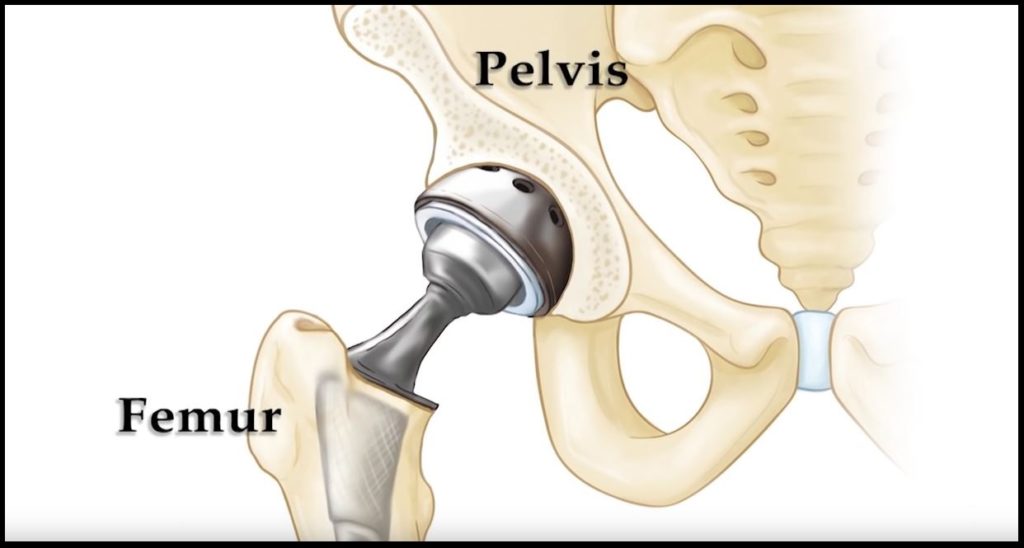 Total hip arthroplastt