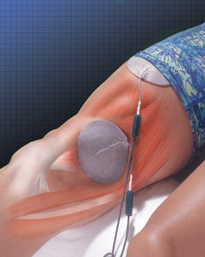 Knee neuromuscular electrical stimulation
