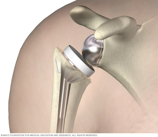 Reverse Shoulder Arthroplasty